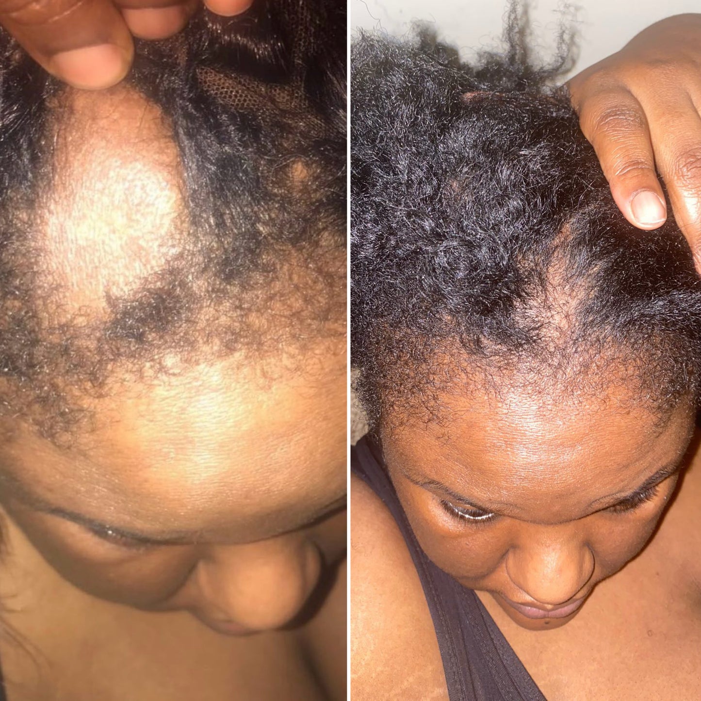 Hair Trifecta- For Hairloss & Dandruff