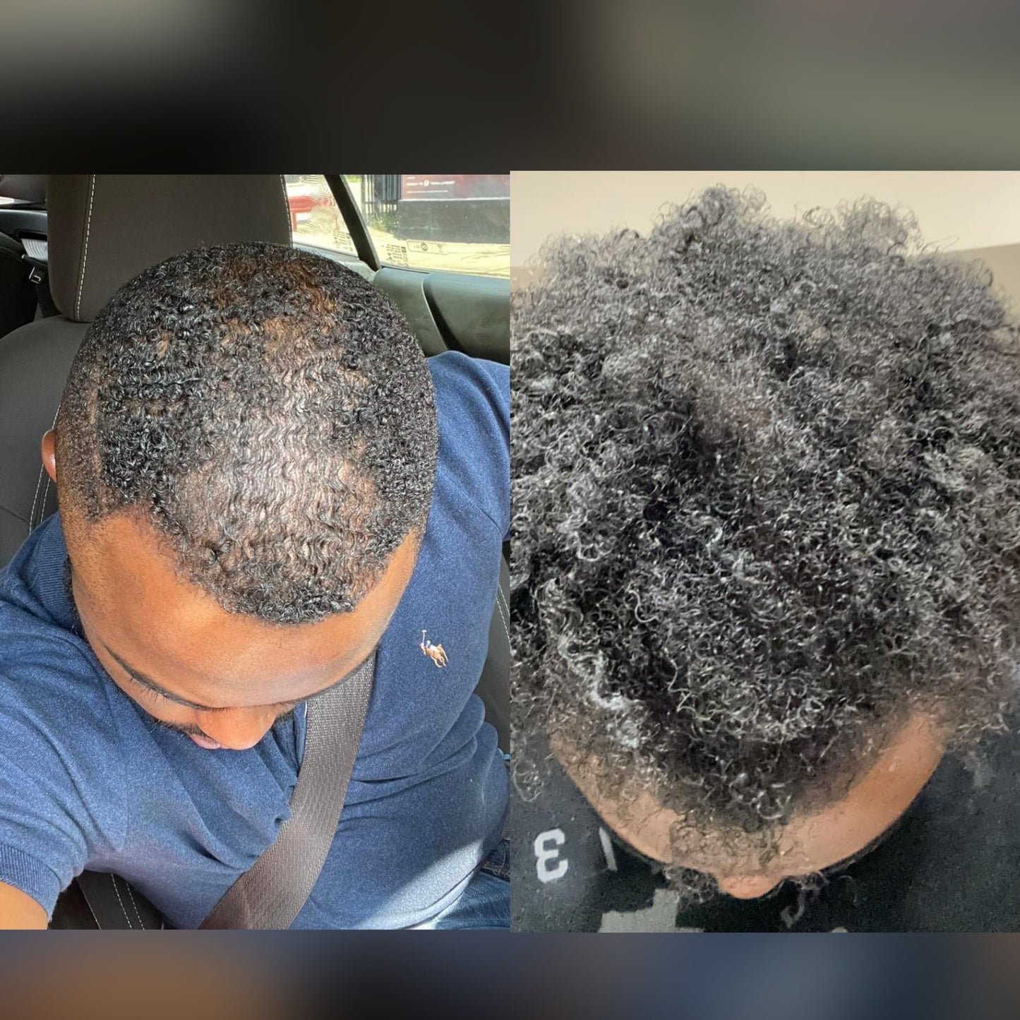 Hair Trifecta- For Hairloss & Dandruff