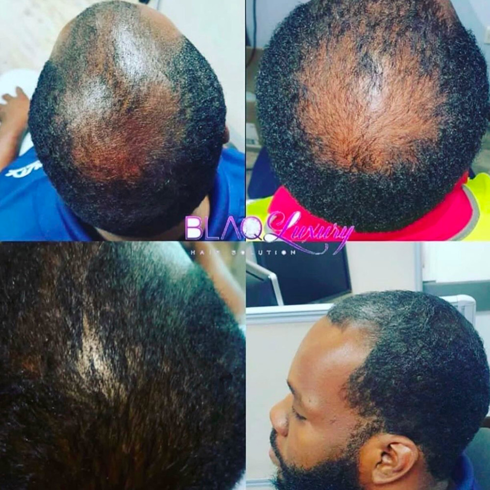 Mega Gro Hair Serum-For Hair Growth